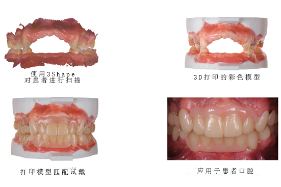 3Shape彩色工作流程，讓牙齒假體越來越“真”！